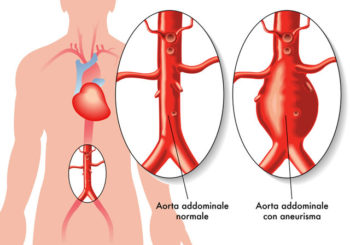 Aneurisma dell’Aorta Addominale: la Diagnosi tempestiva può salvare la VITA!!!