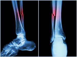 Fracture shaft of fibula bone ( leg bone ) .  X-ray of leg ( 2 position : side and front view )