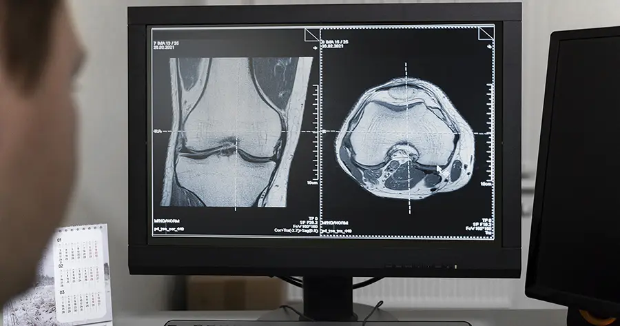 Risonanza magnetica dei distretti articolari dopo trauma- quando serve?