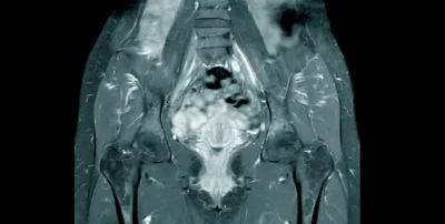 Cosa si vede con la risonanza magnetica al bacino?